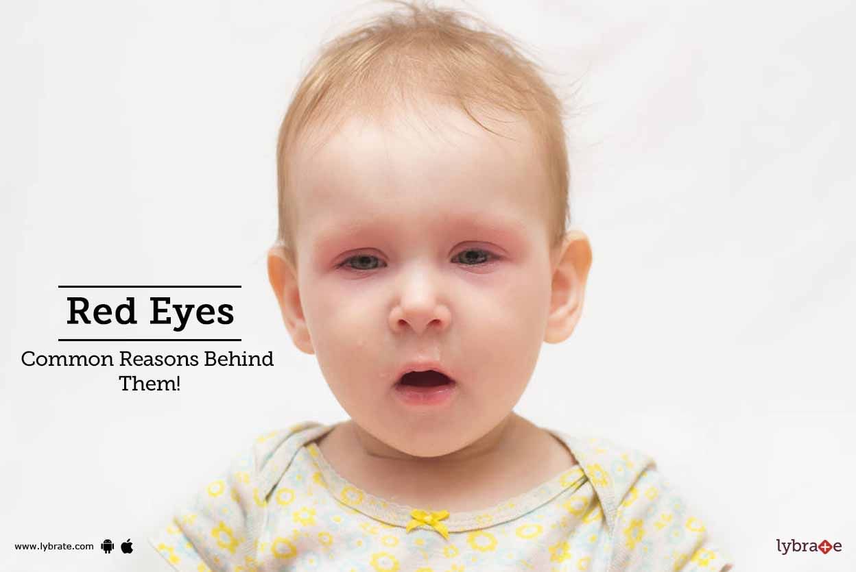 Red Eyes - Common Reasons Behind Them!