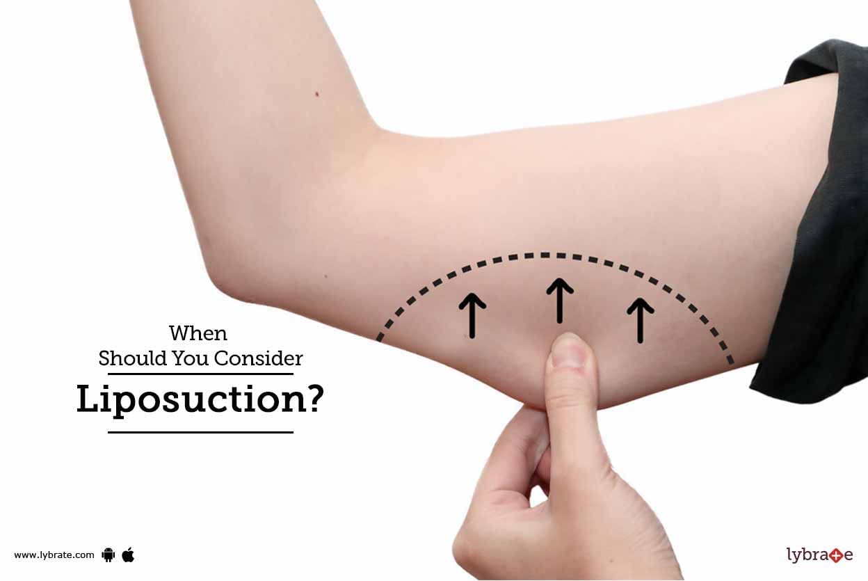 When Should You Consider Liposuction?