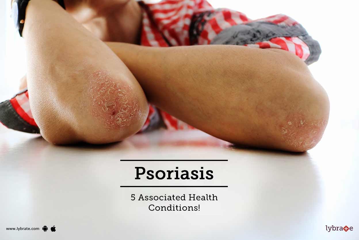 Psoriasis - 5 Associated Health Conditions!