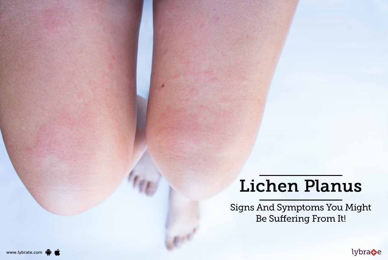 Lichen Planus - Signs And Symptoms You Might Be Suffering From It!
