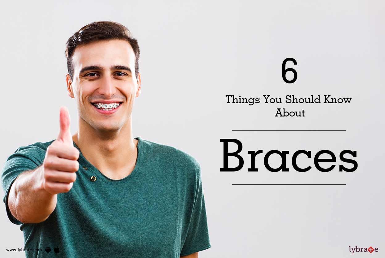 6 Things You Should Know About Braces