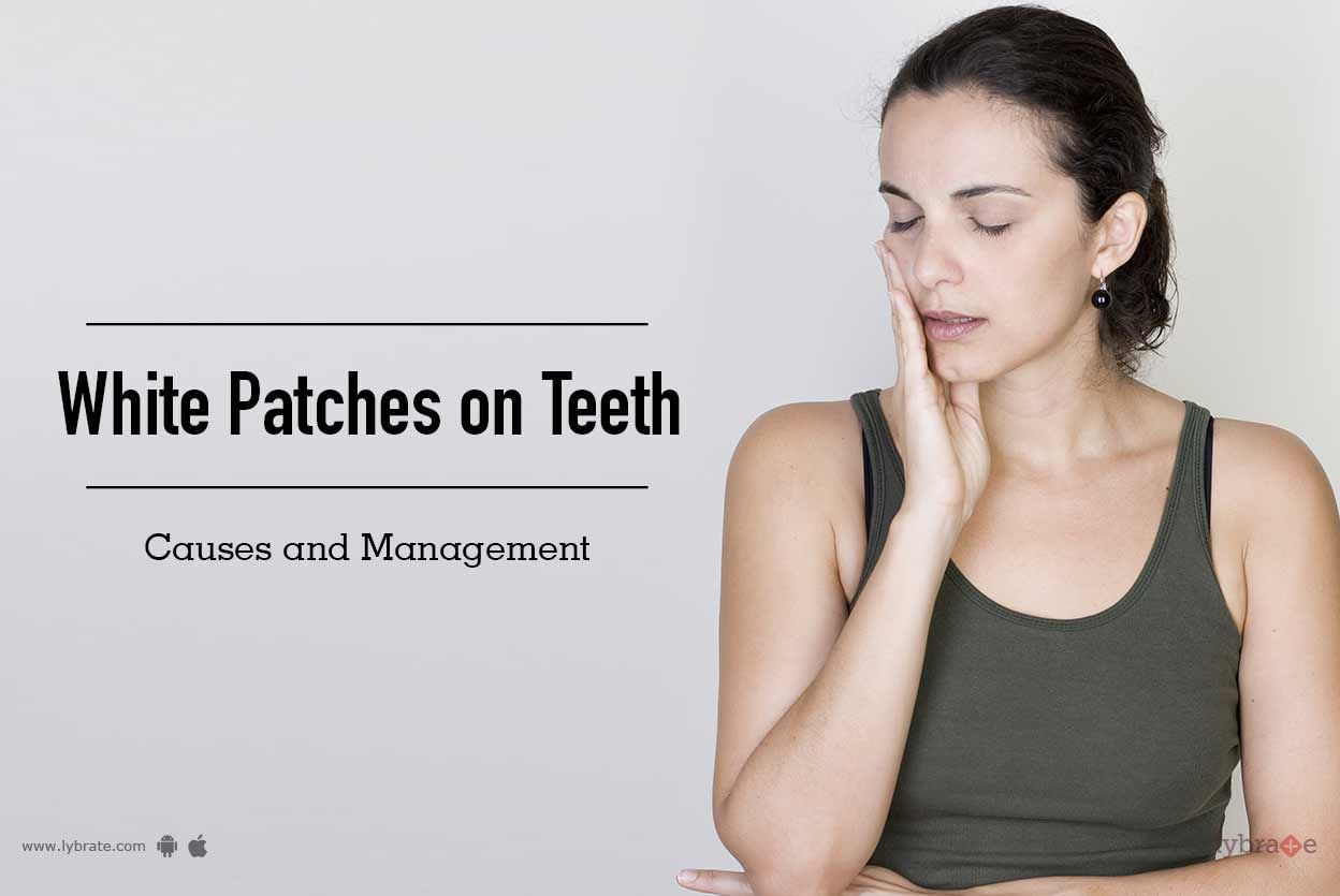 White Patches on Teeth - Causes and Management