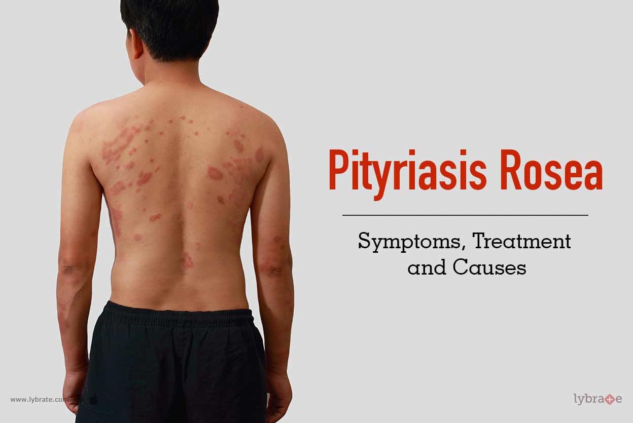 Pityriasis Rosea Causes Symptoms Treatment Pityriasis Rosea Sexiz Pix Sexiz Pix