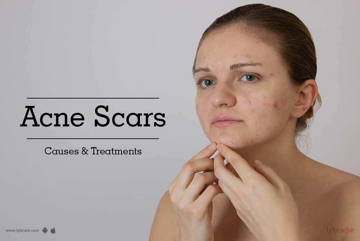 Acne Scars Causes And Treatments By Dr Archhana Gullur Lybrate