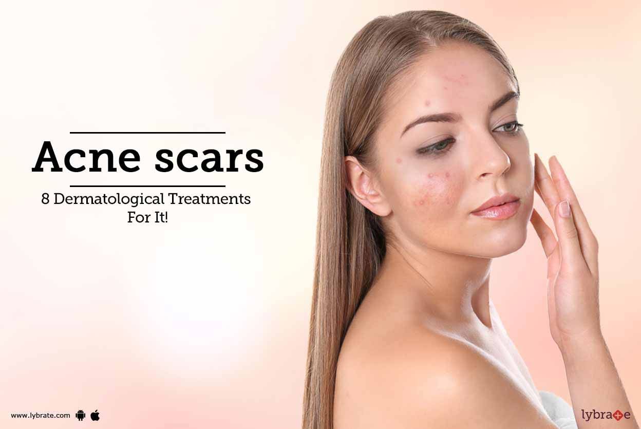 Acne scars - 8 Dermatological Treatments For It!
