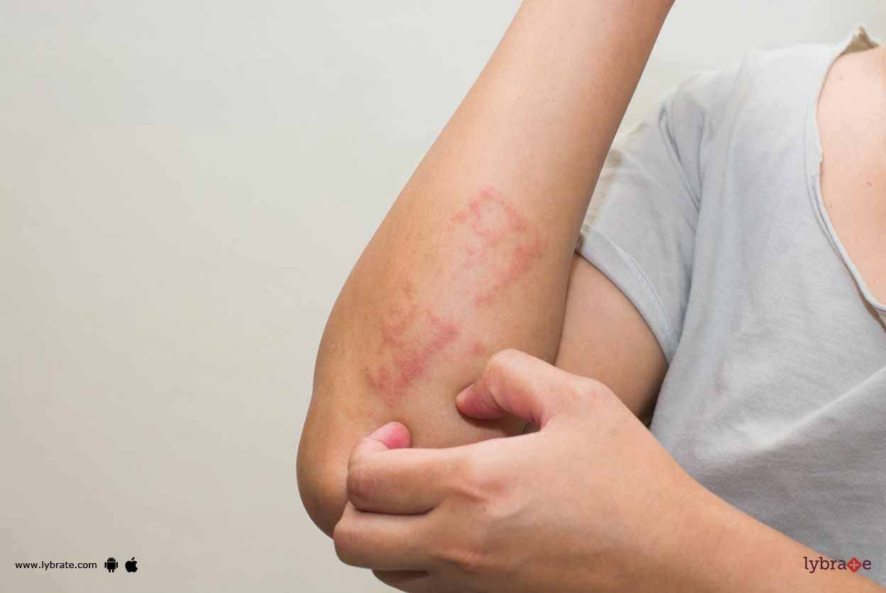 Eczema - 5 Homeopathic Treatments For It!
