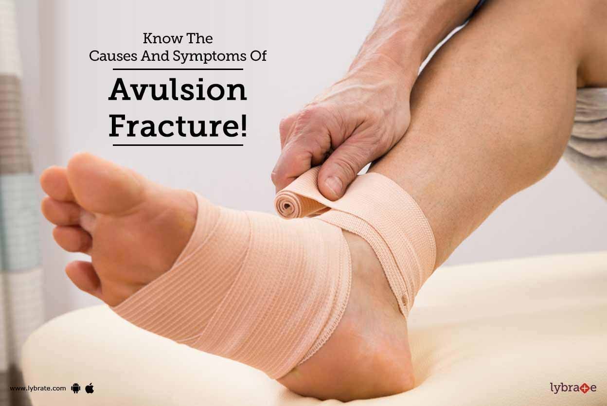 Know The Causes And Symptoms Of Avulsion Fracture!