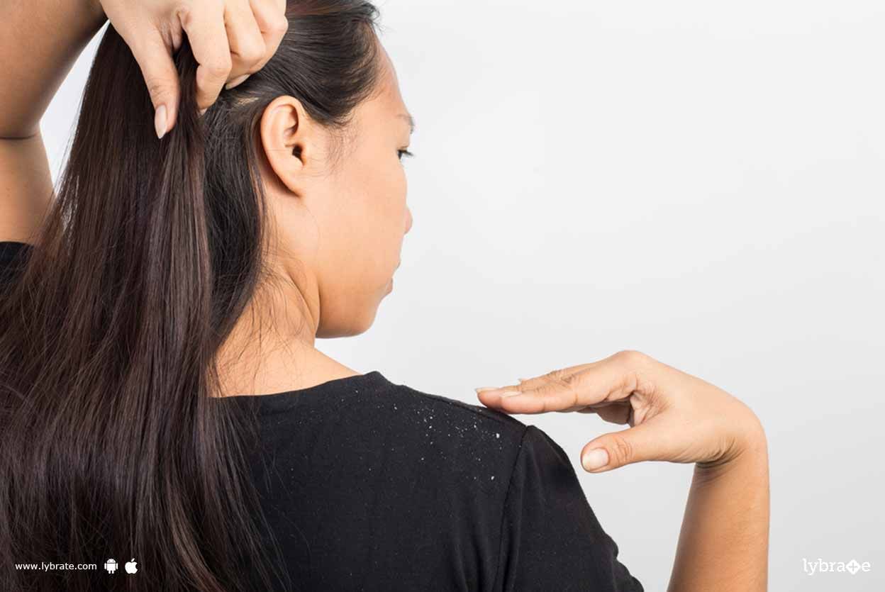 Dandruff - 4 Things That Are The Real Reasons Behind It!