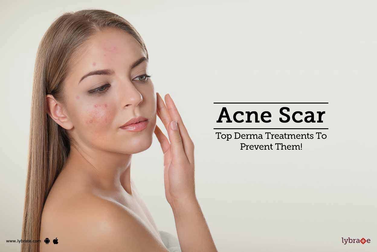 Acne Scar - Top Derma Treatments To Prevent Them!
