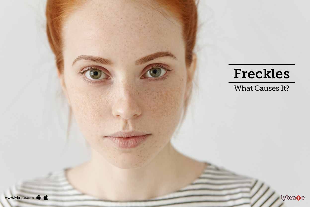 Freckles - What Causes It?