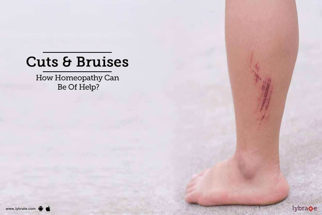 Cuts & Bruises - How Homeopathy Can Be Of Help?