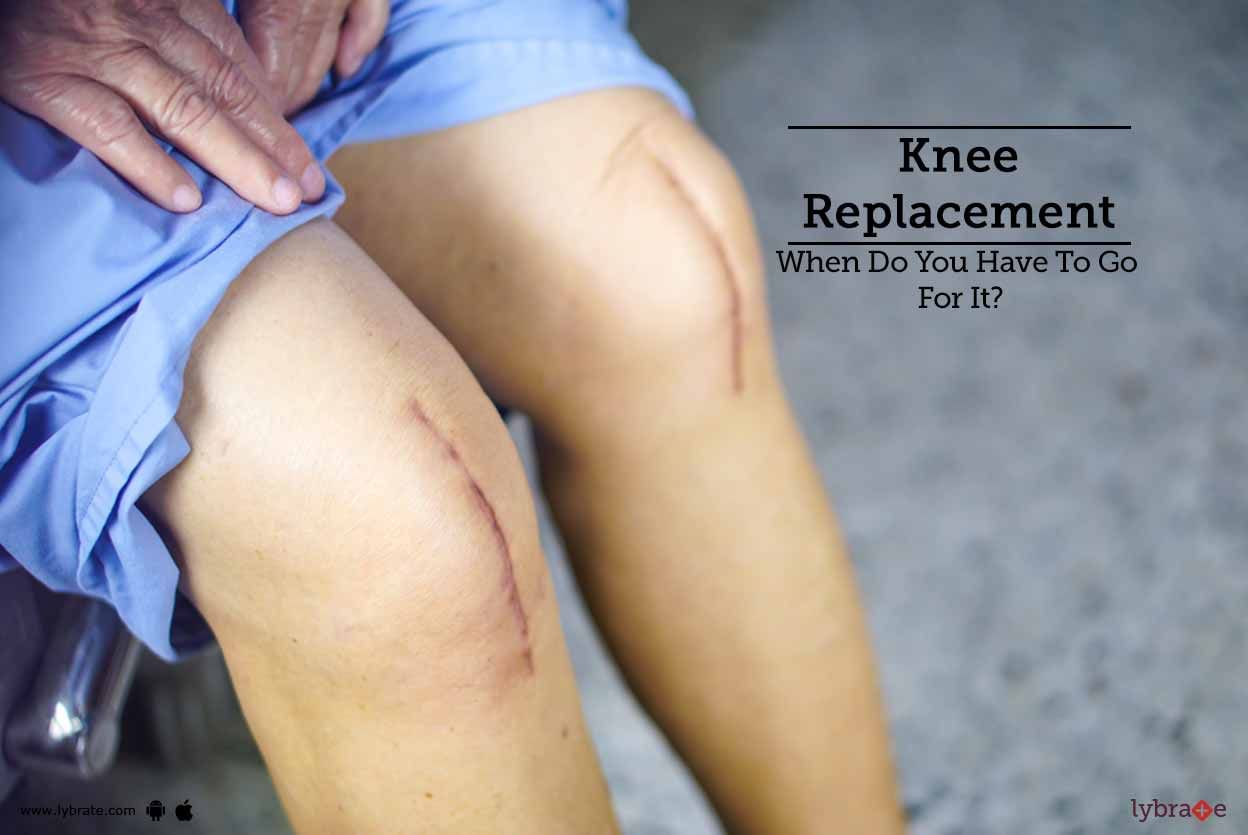 Knee Replacement - When Do You Have To Go For It?