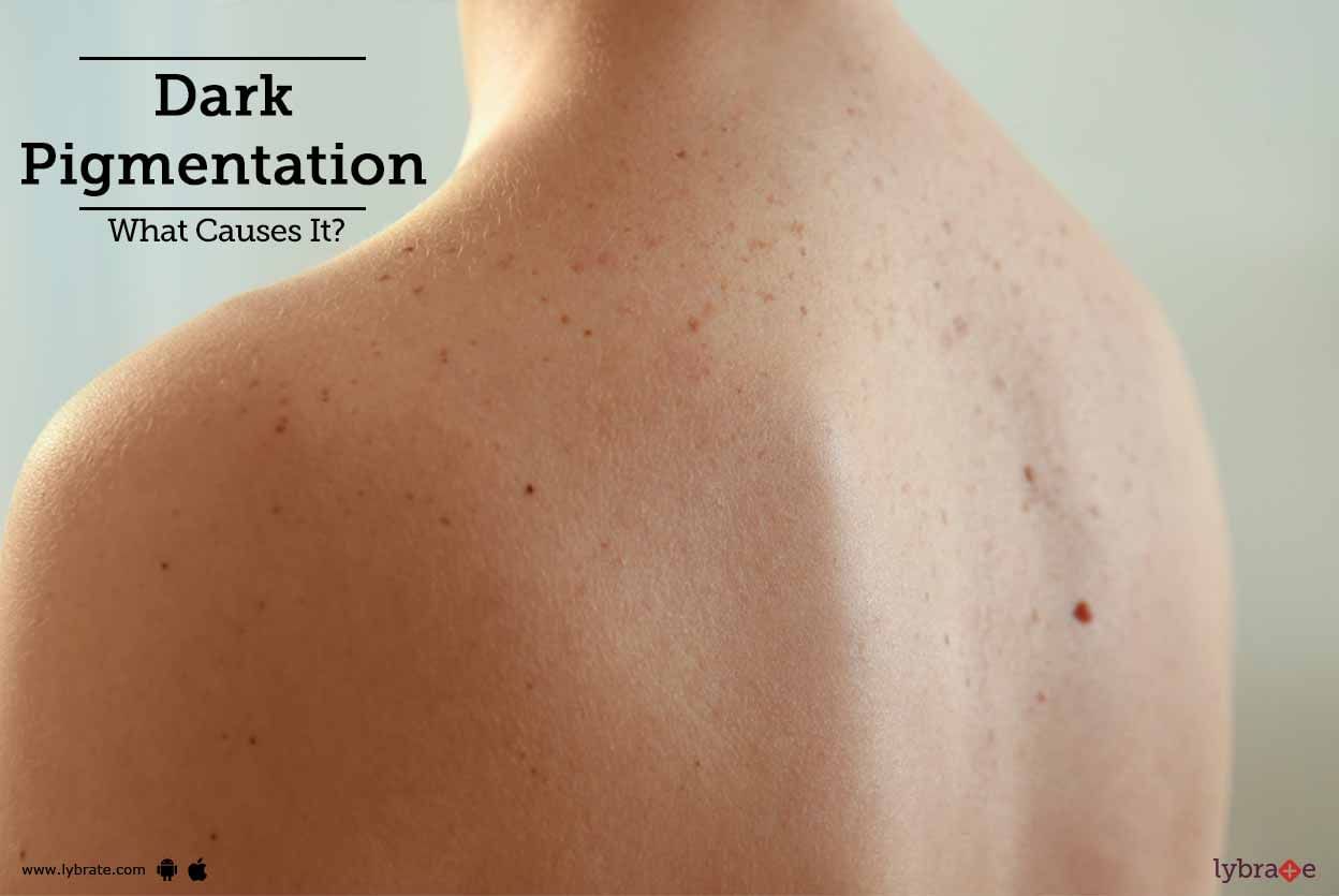 Dark Pigmentation - What Causes It?