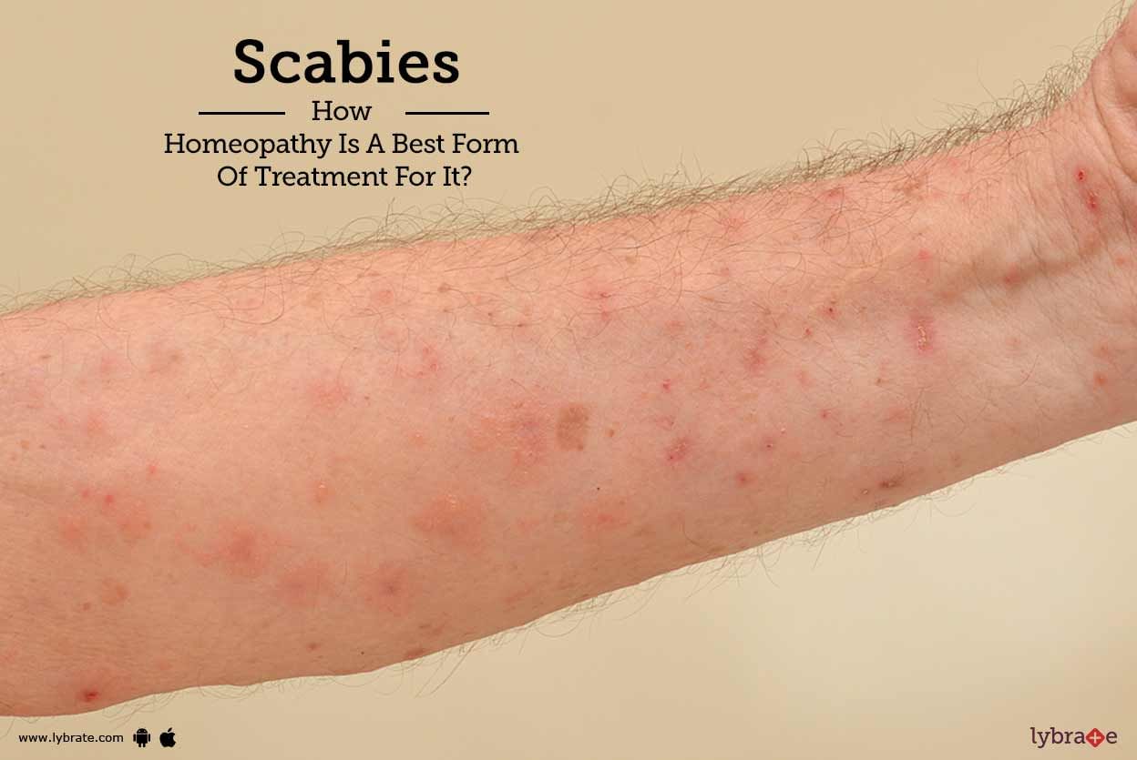 Scabies - How Homeopathy Is A Best Form Of Treatment For It?