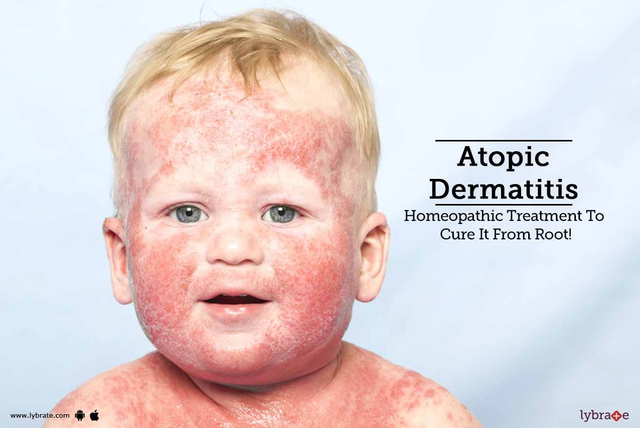 Atopic Dermatitis: Homeopathic Treatment To Cure It From Root!