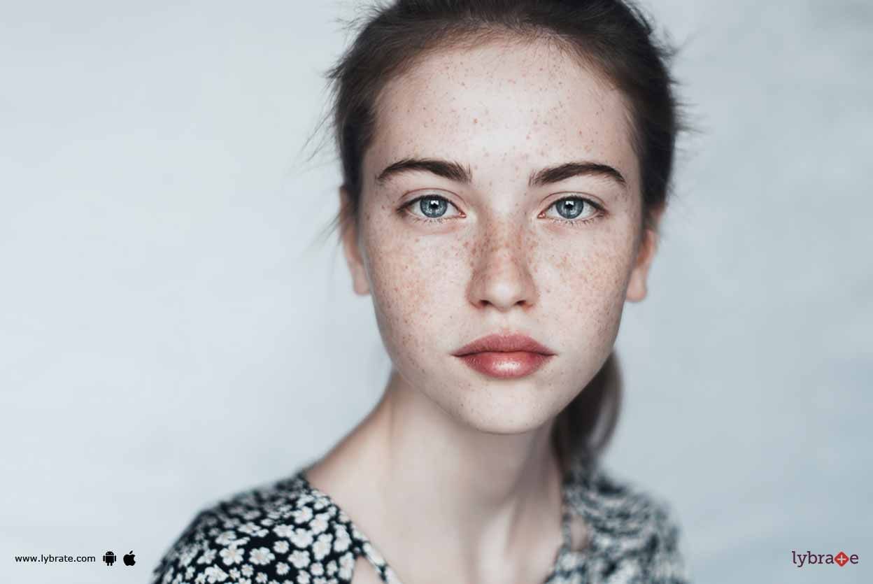 Freckles - Ways To Deal With The Same!