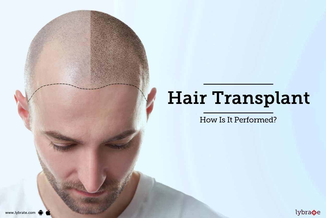 Hair Transplant - How Is It Performed?