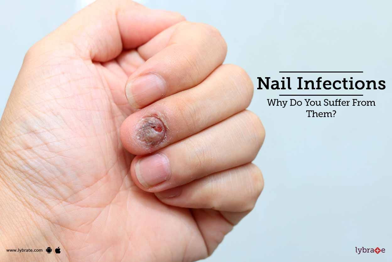 Nail Infections - Why Do You Suffer From Them?