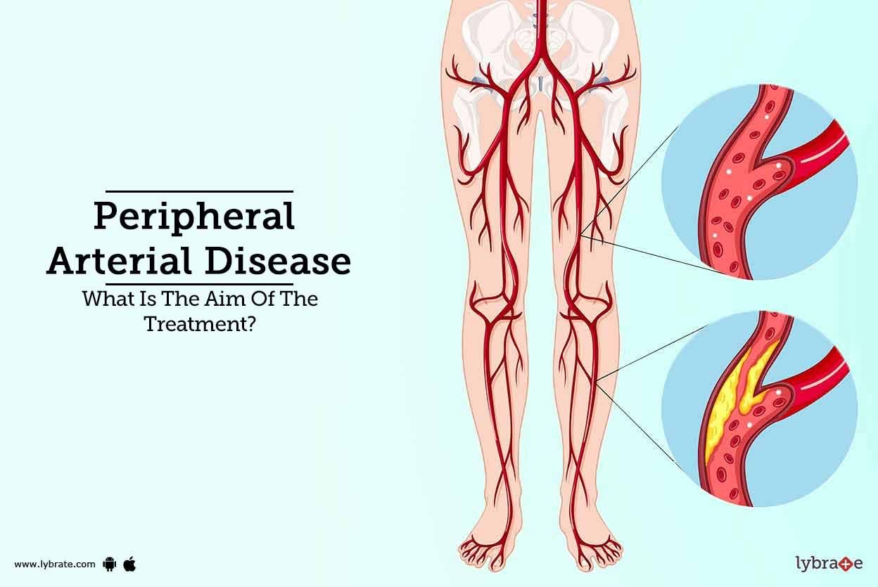 Peripheral Arterial Disease - What Is The Aim Of The Treatment?