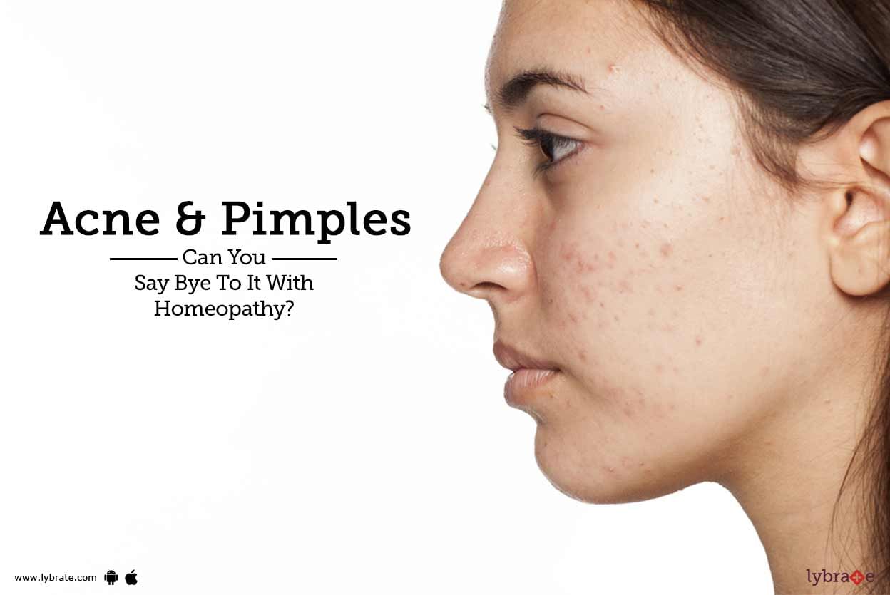 Acne & Pimples - Can You Say Bye To It With Homeopathy?