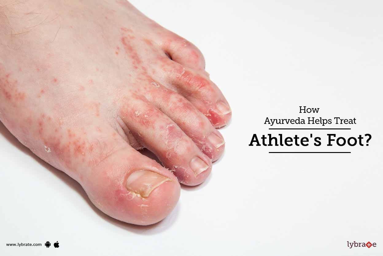 How Ayurveda Helps Treat Athlete's Foot?