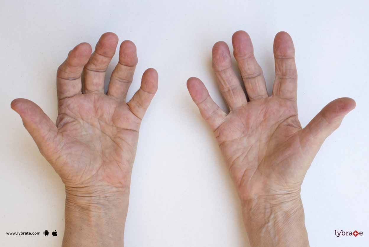 Rheumatoid Arthritis - Know Its Symptoms And Treatment!