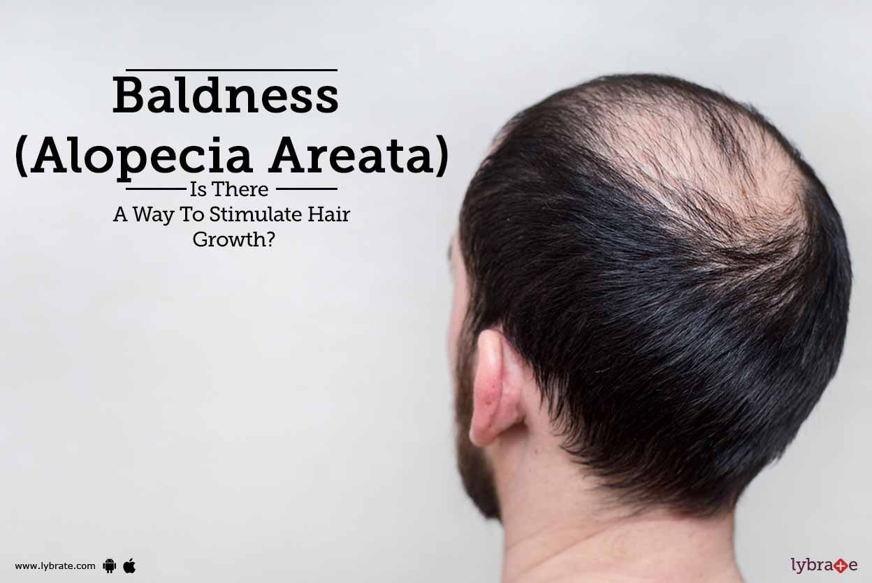 Baldness (Alopecia Areata) - Is There A Way To Stimulate Hair Growth?