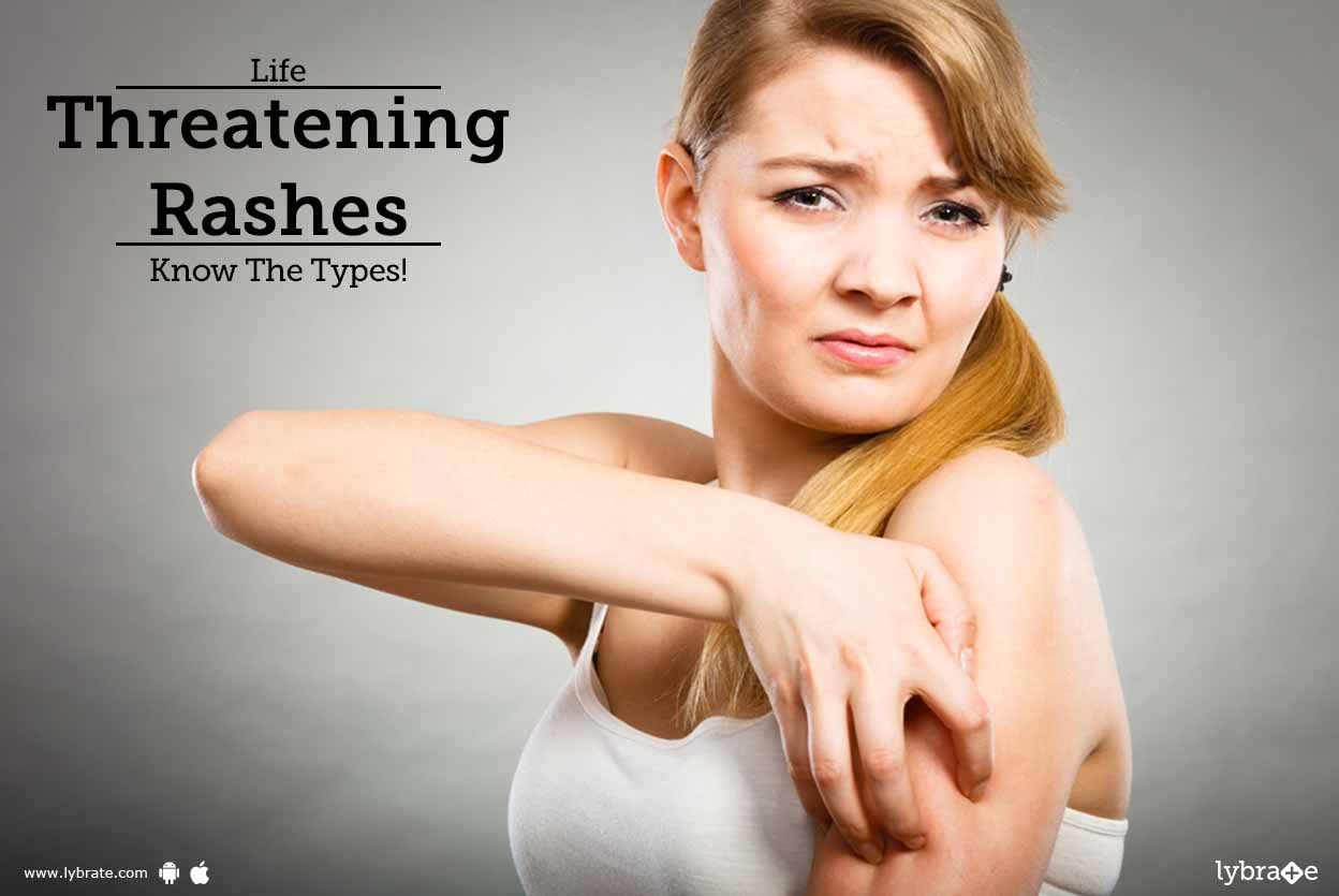 Life Threatening Rashes - Know The Types!