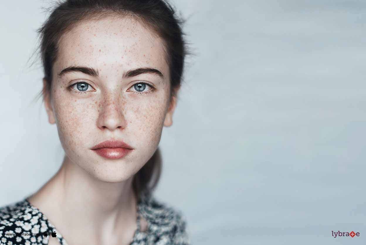 Melasma vs Hyperpigmentation - What Is The Difference?