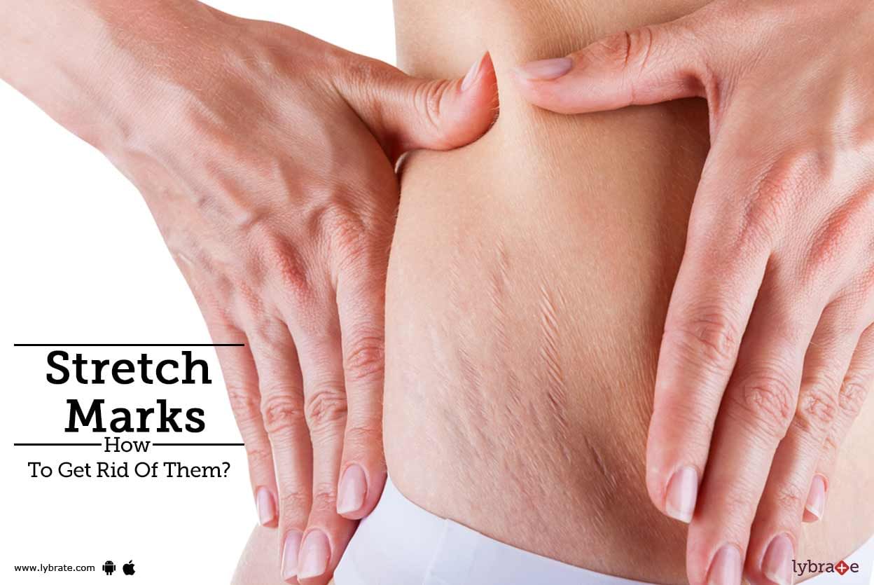 Stretch Marks - How To Get Rid Of Them?