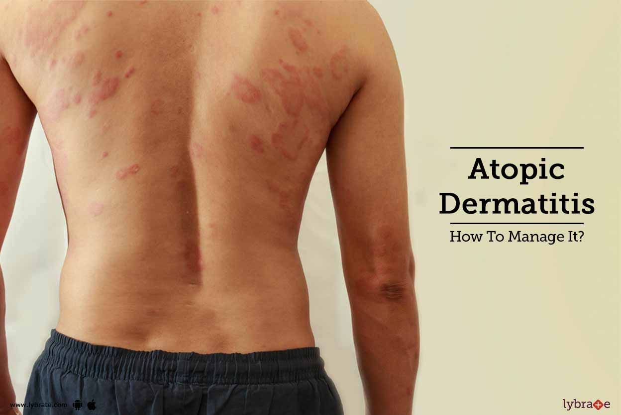Atopic Dermatitis - How To Manage It?