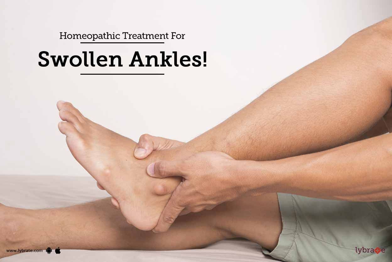 Homeopathic Treatment For Swollen Ankles!
