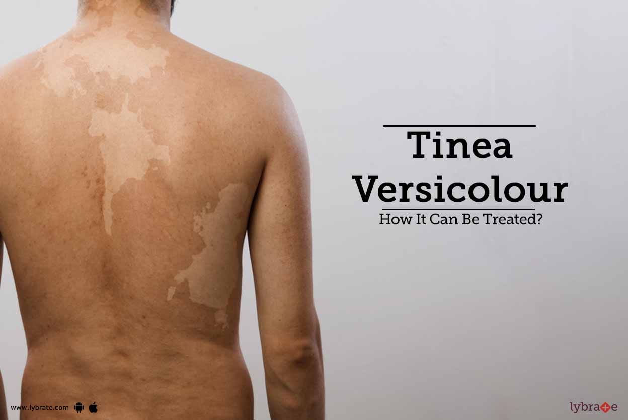 Tinea Versicolour - How It Can Be Treated?