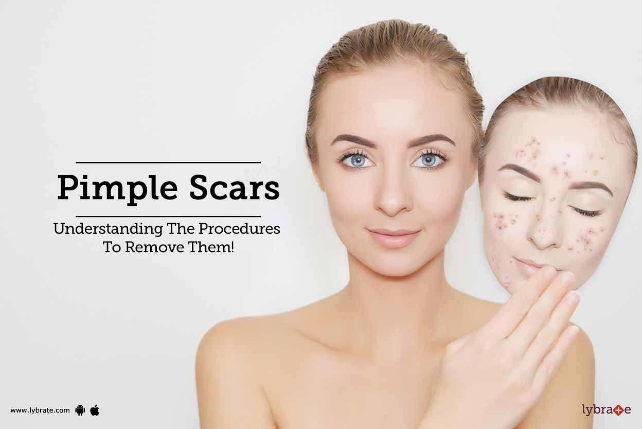 Pimple Scars - Understanding The Procedures To Remove Them!