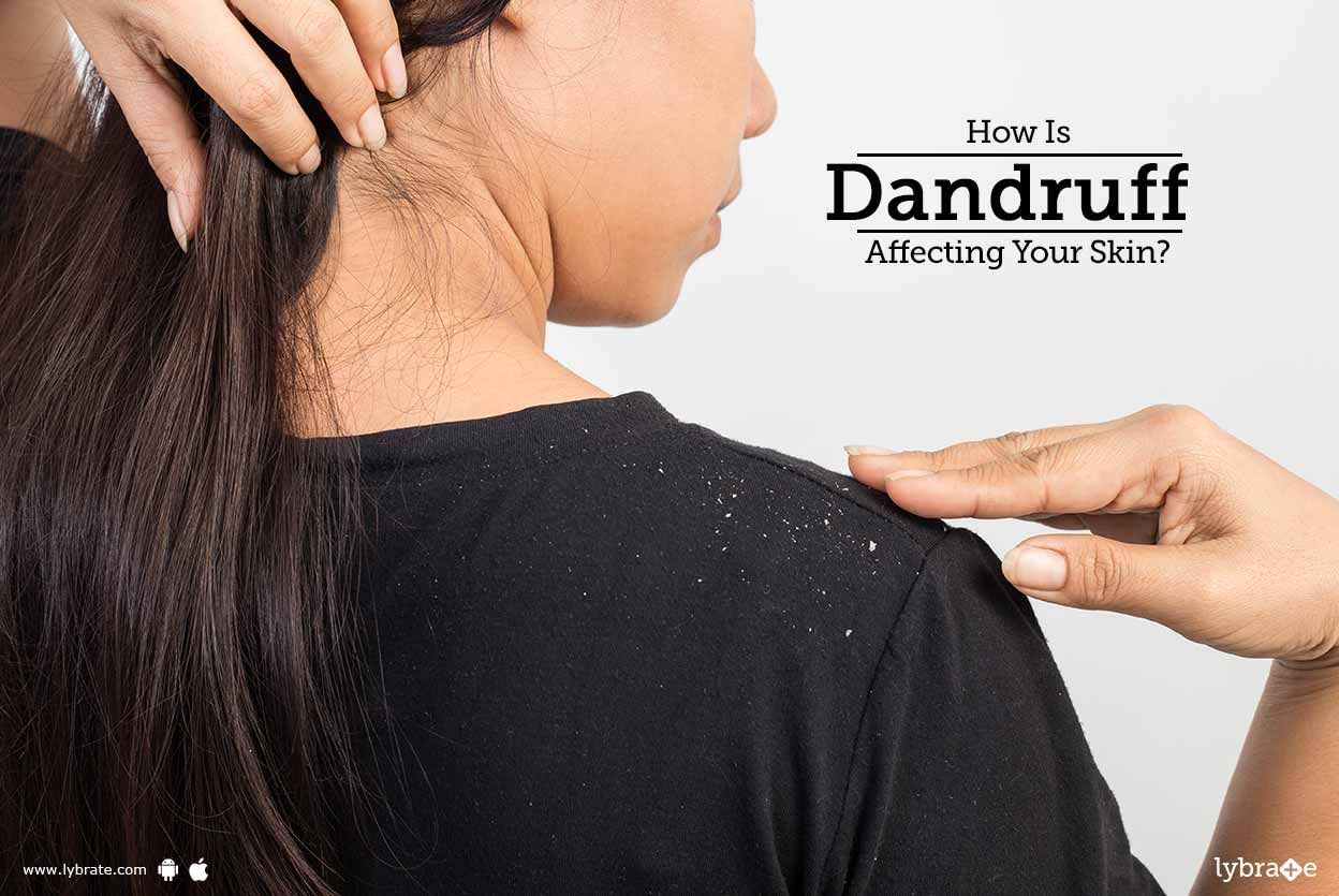 How Is Dandruff Affecting Your Skin?