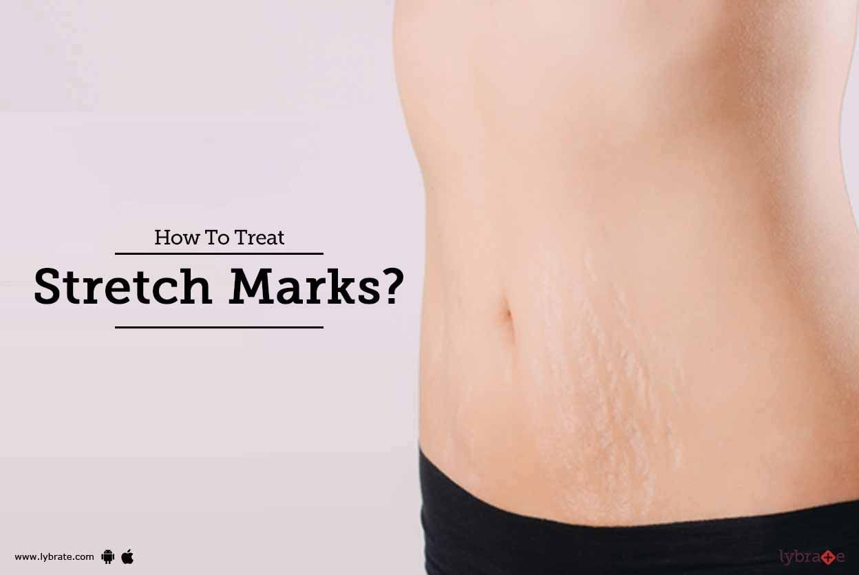 How To Treat Stretch Marks?
