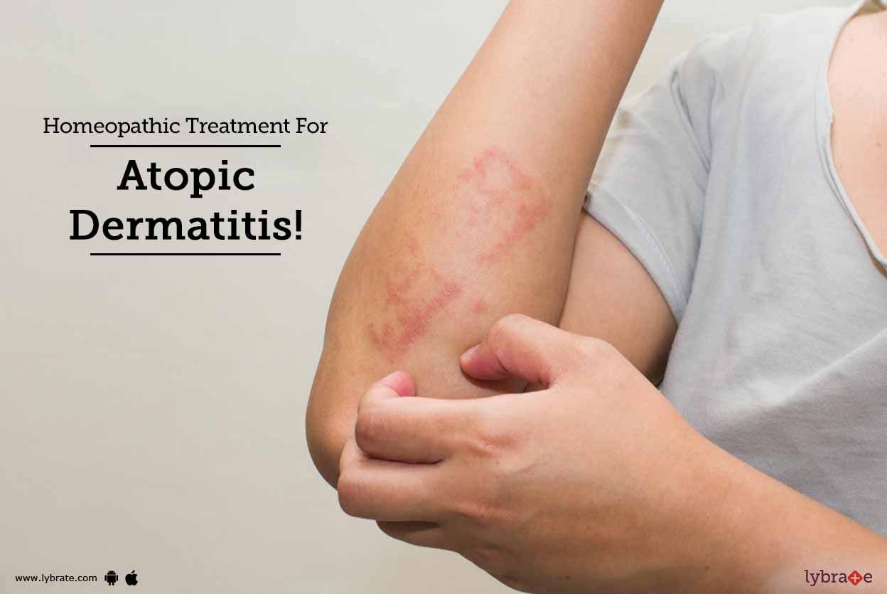 Homeopathic Treatment For Atopic Dermatitis!