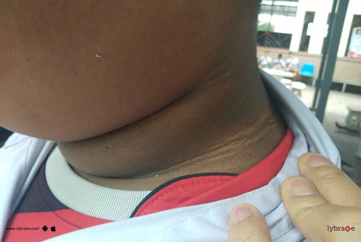 Acanthosis Nigricans - Investigation And Management!