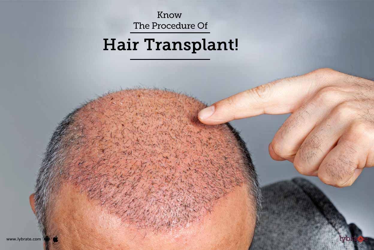 Know The Procedure Of Hair Transplant!