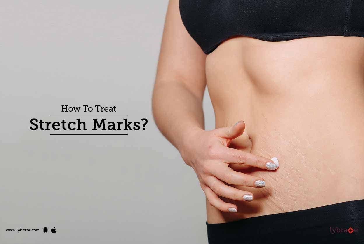 How To Treat Stretch Marks?
