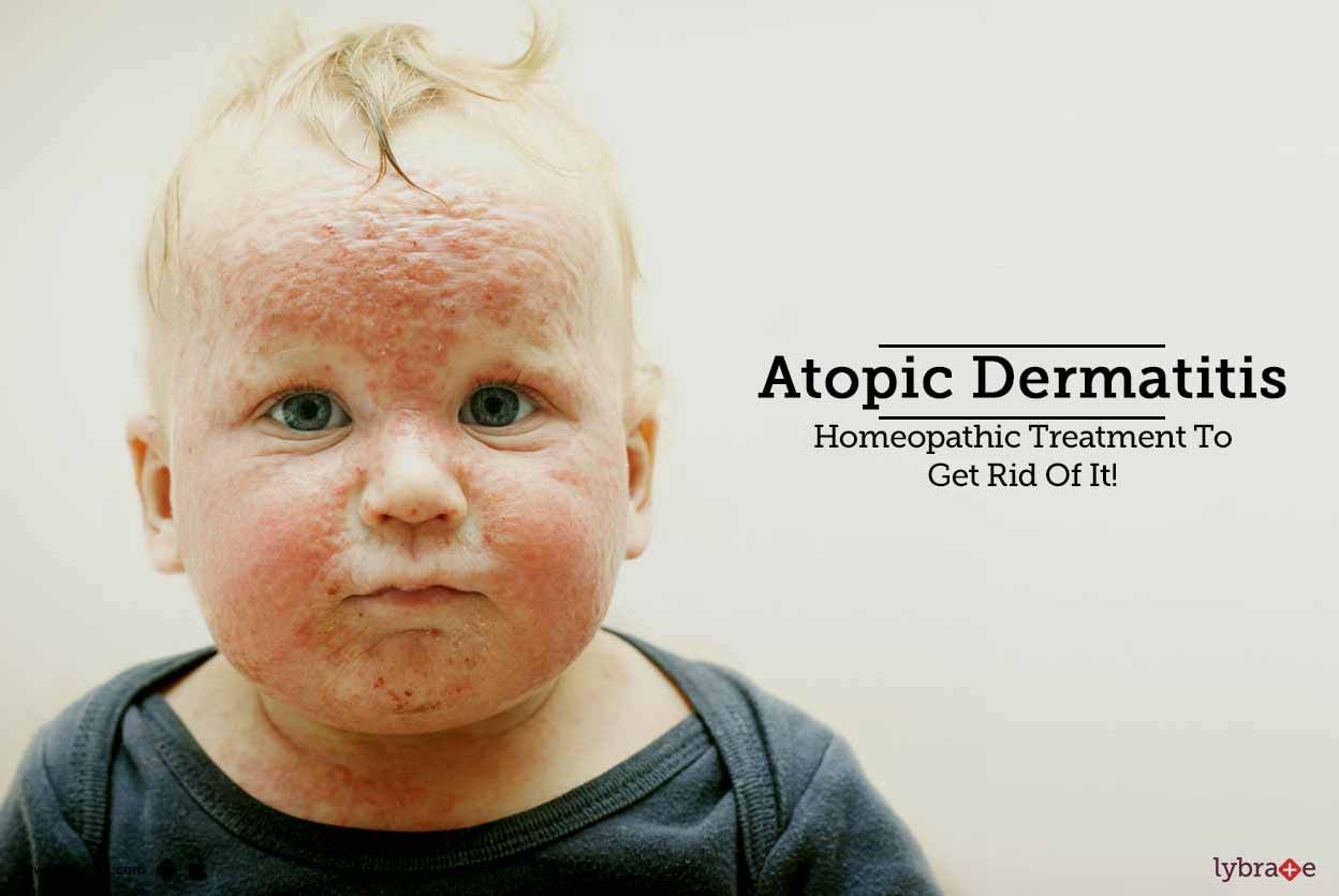 Atopic Dermatitis: Homeopathic Treatment To Get Rid Of It!