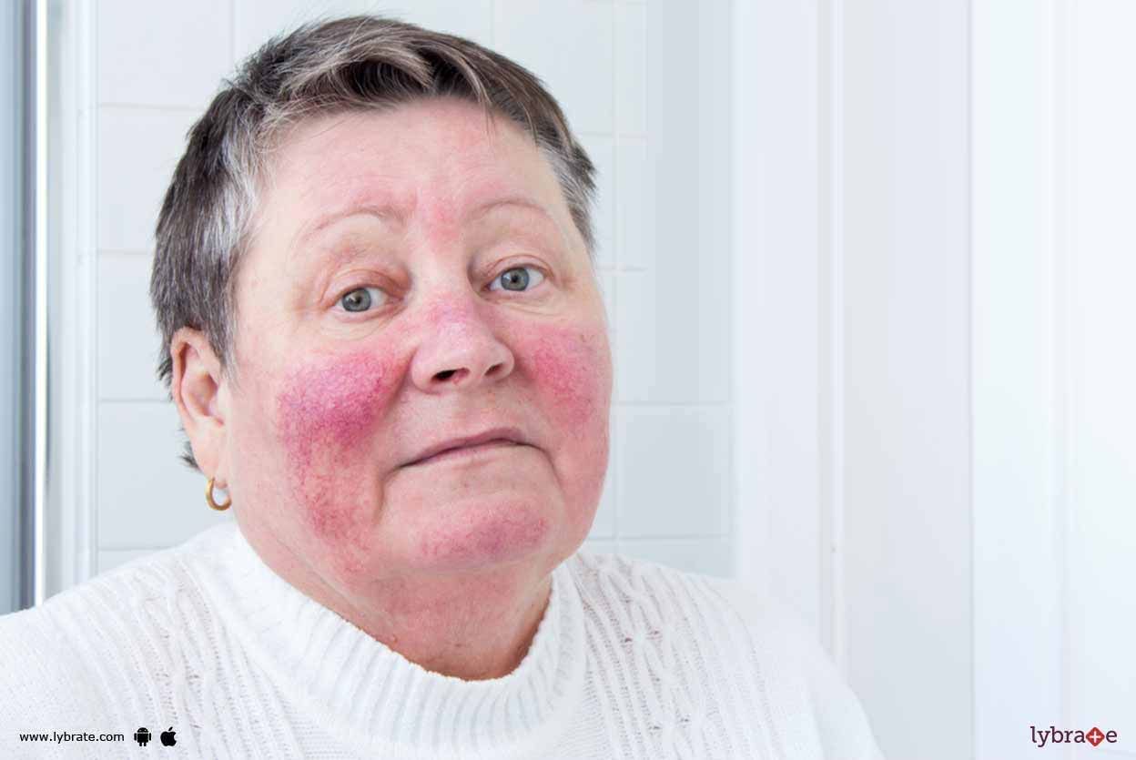 Can Rosacea Be Treated With Homeopathy?