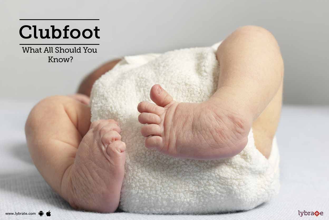 Clubfoot - What All Should You Know?