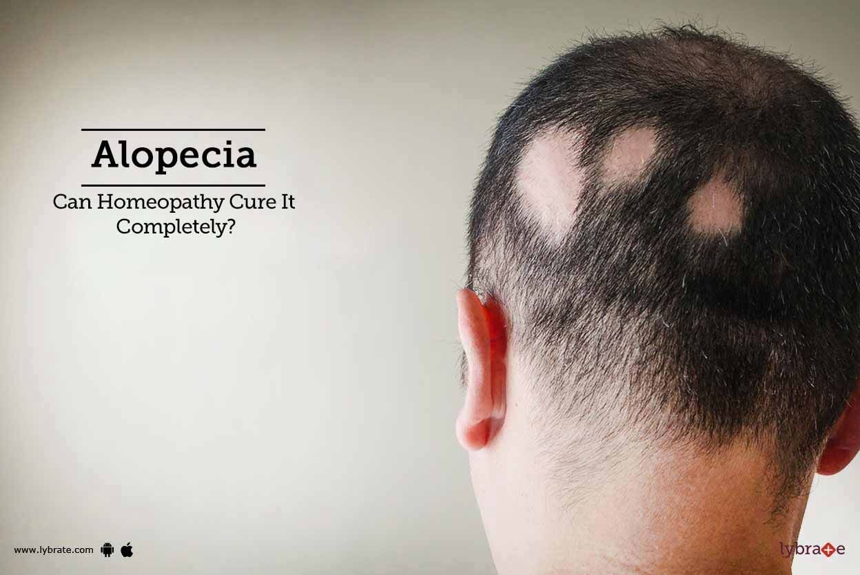 Alopecia - Can Homeopathy Cure It Completely?