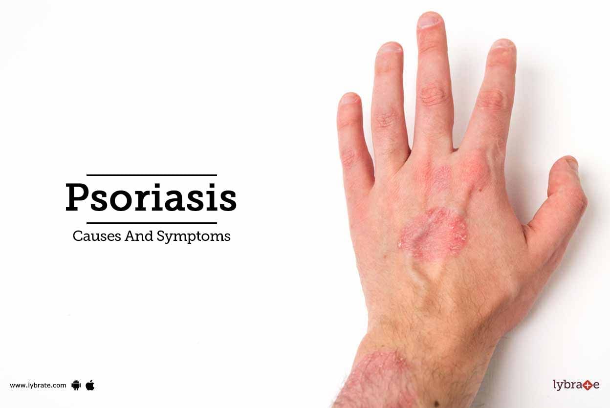 Psoriasis - Causes And Symptoms