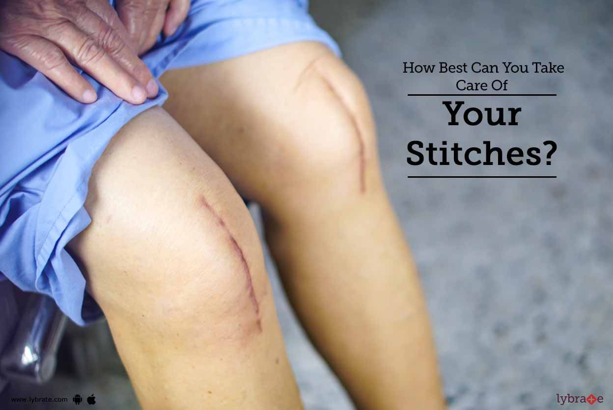 How Best Can You Take Care Of Your Stitches?
