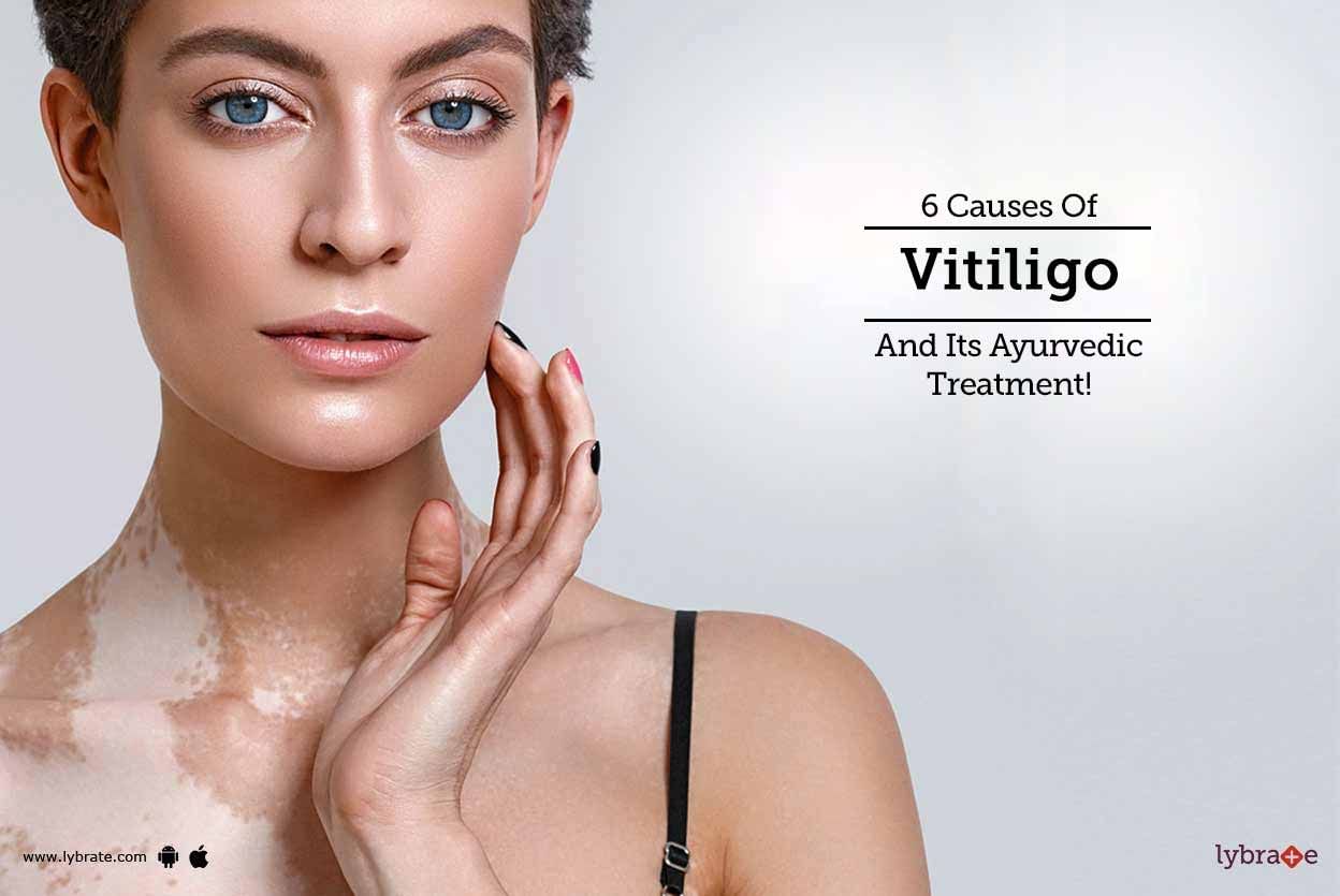 6 Causes Of Vitiligo And Its Ayurvedic Treatment!