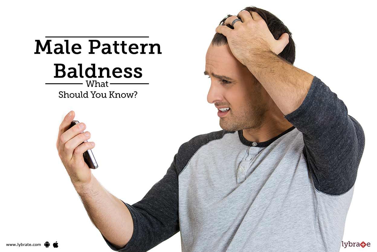 Male Pattern Baldness: What Should You Know?