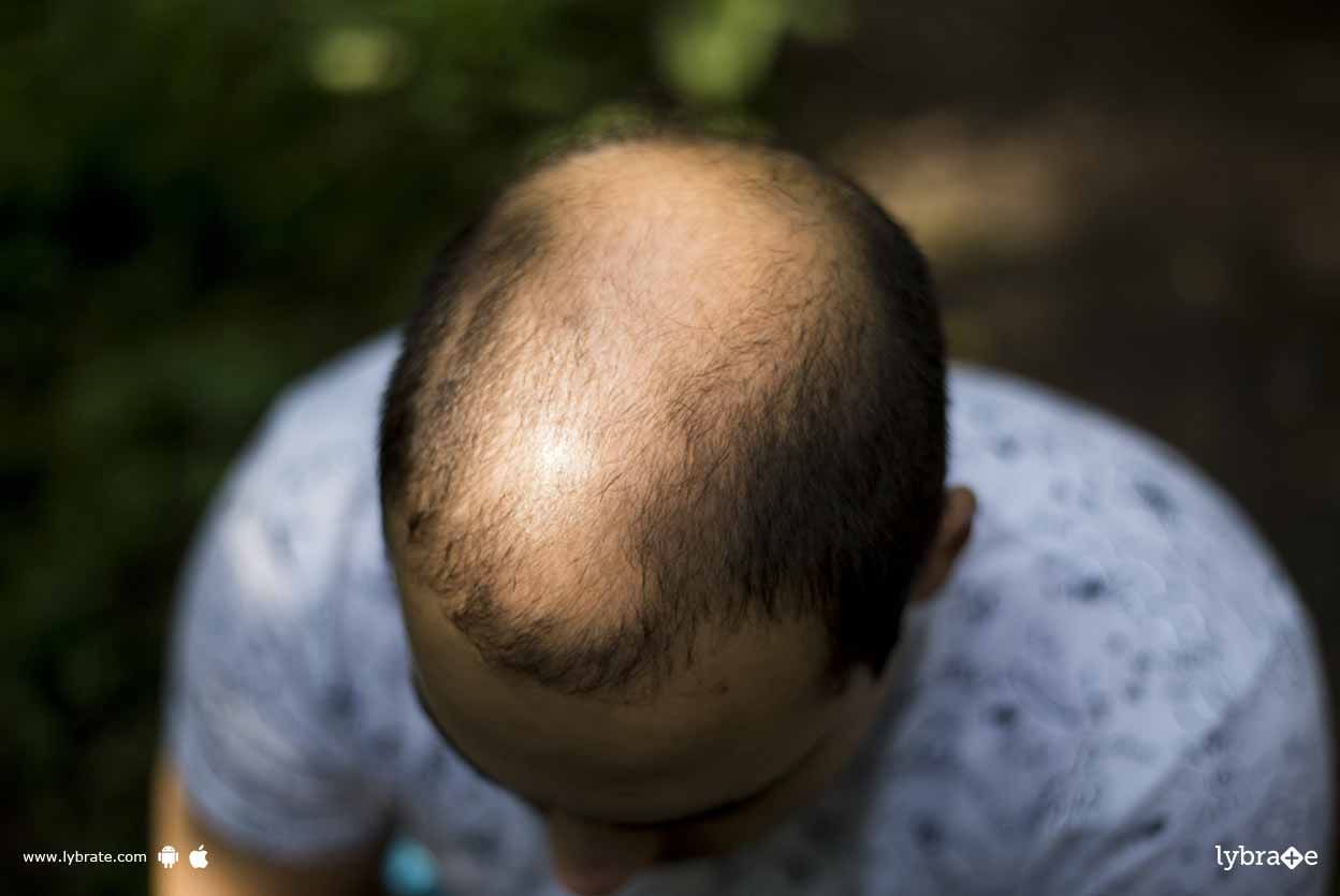 Hair Transplant - Are You Eligible?
