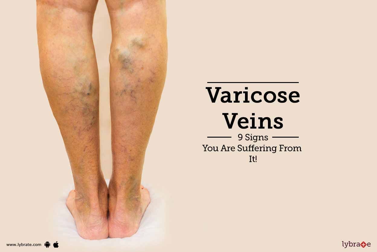 Varicose Veins - 9 Signs You Are Suffering From It!